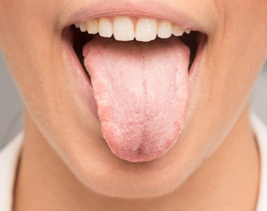 Dry Mouth - Facts and Tips