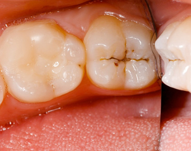 How to Assess Your Risk for Tooth Decay