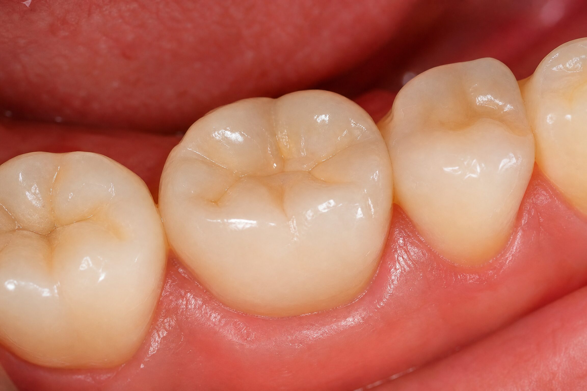 Dental crown placed after root canal therapy at Charlottesville Dental Associates