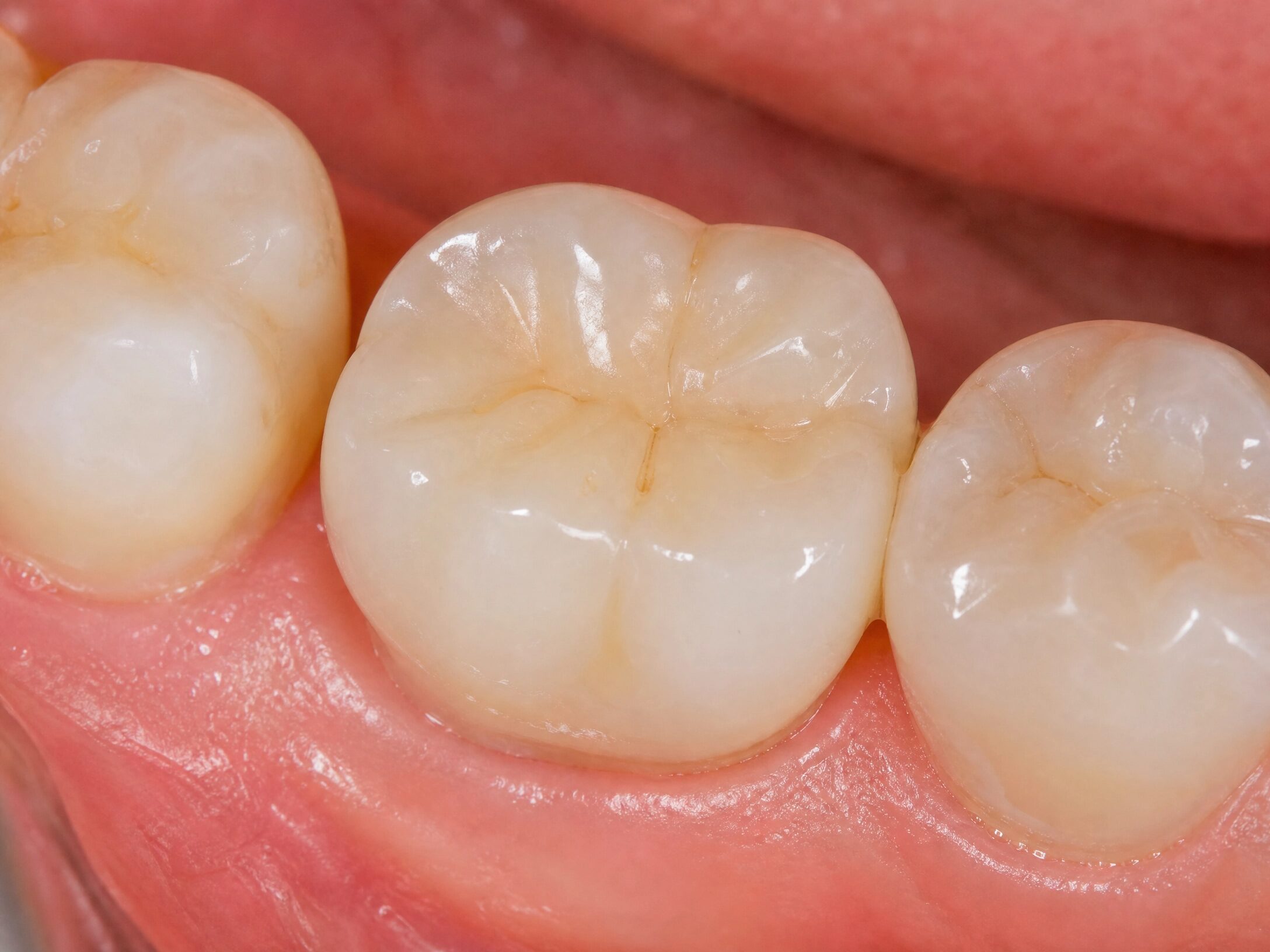 Custom implant crown at Charlottesville Dental Associates