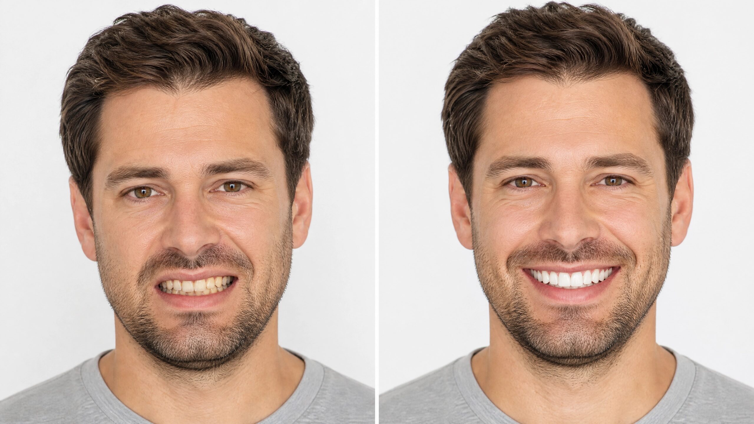 Before and after dental implants at Charlottesville Dental Associates